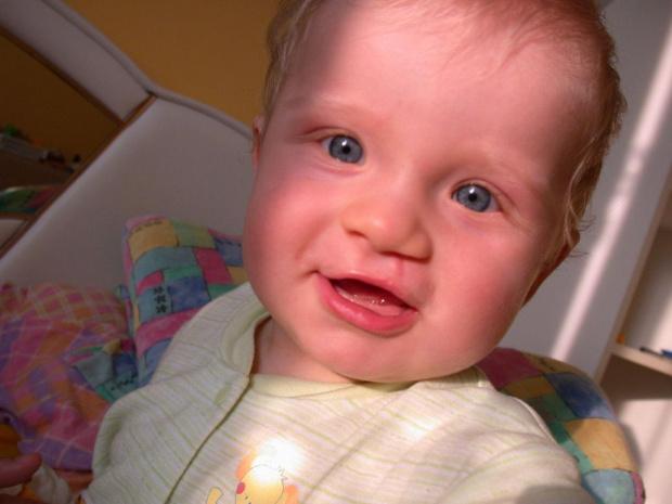 Karolek ur. 15 VIII 2006 jednostronny rozszczep wargi podniebienia miękkiego i tylnej części twardego operacja 1 II 2007 Kozia